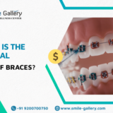 What is the normal cost of braces