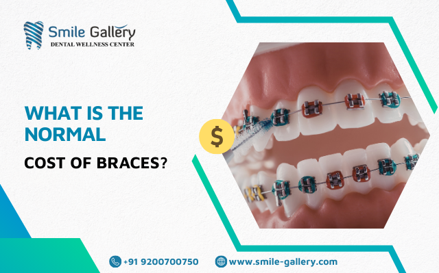 What is the normal cost of braces
