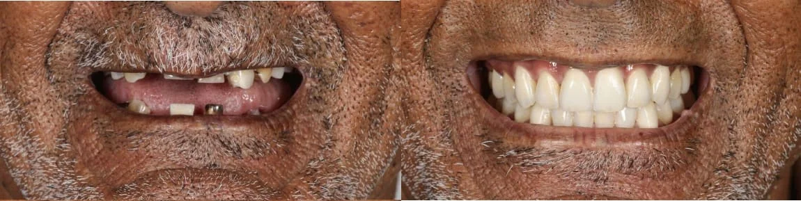 Dental Implants in Bhopal | Smile Gallery