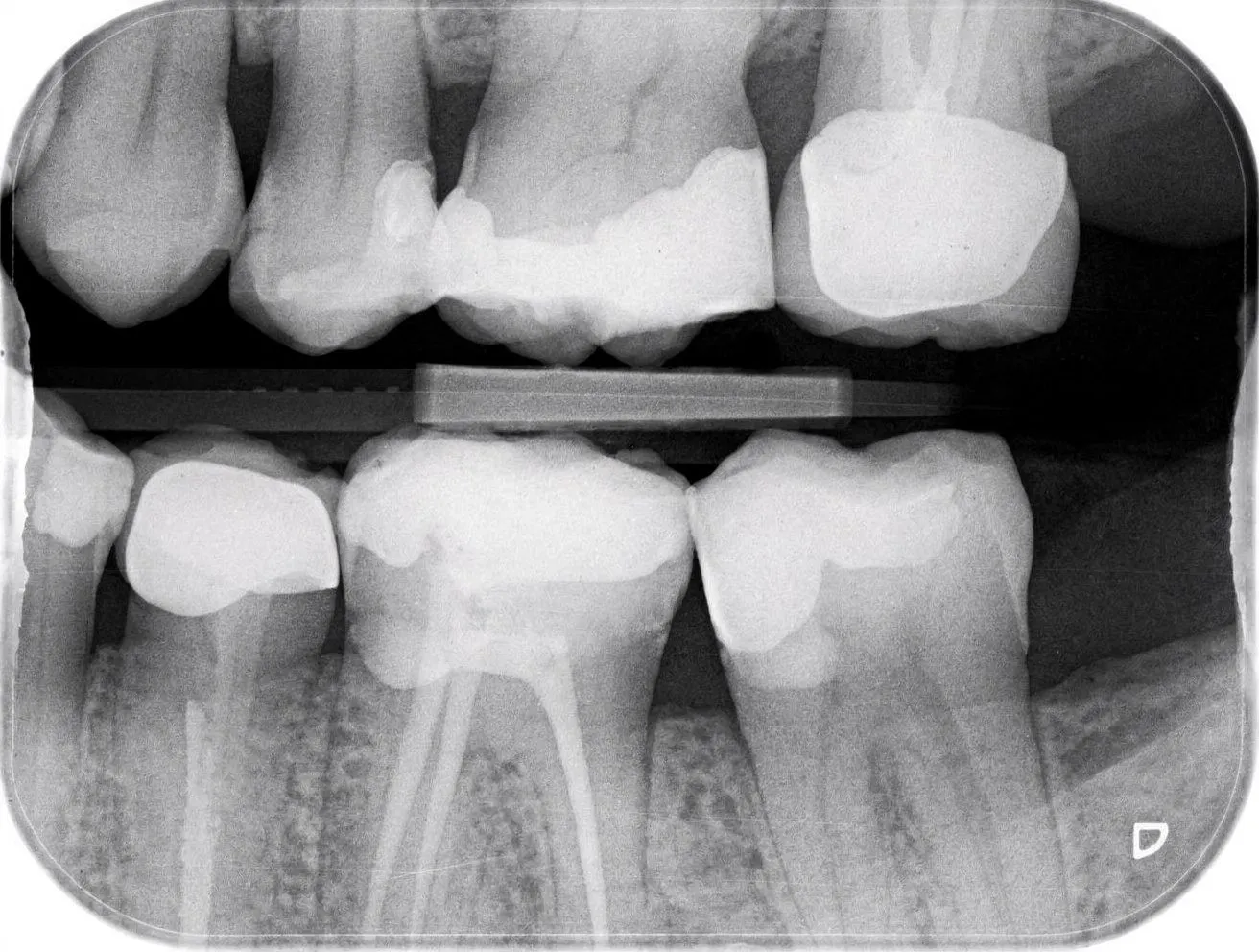 Bitewing X-ray showing upper and lower posterior teeth with amalgam/composite fillings; diagnostic mood