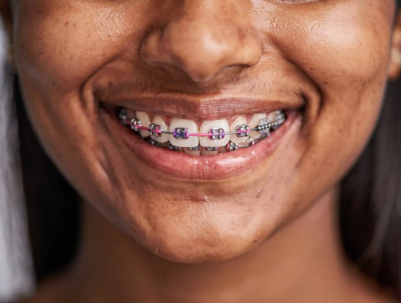 Young dark-skinned woman with colourful pink/purple braces ligatures; cheerful, confident smile