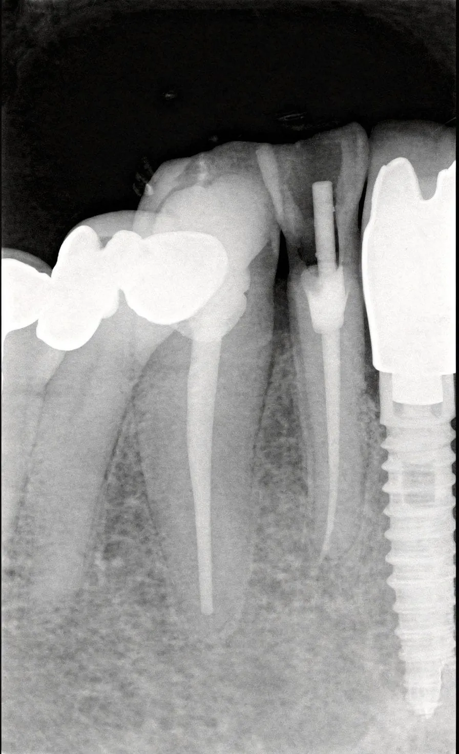 Periapical X-ray showing dental structures