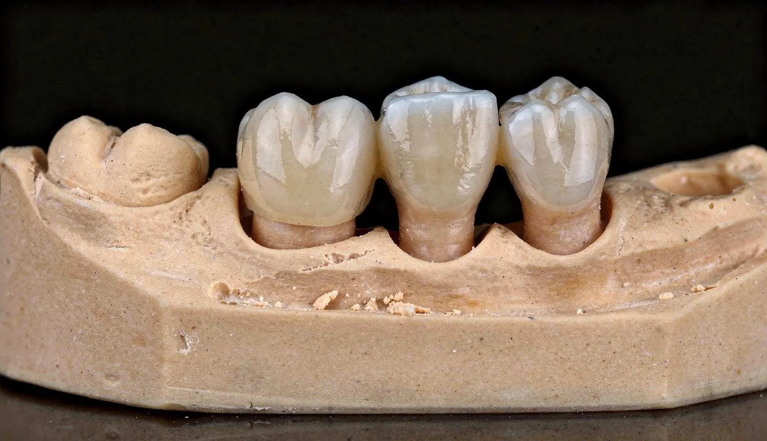 Three ceramic/zirconia posterior crowns seated on plaster dental cast model against dark background