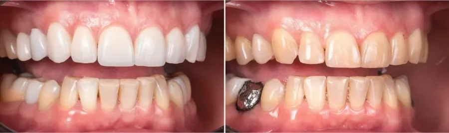 Before/after teeth transformation