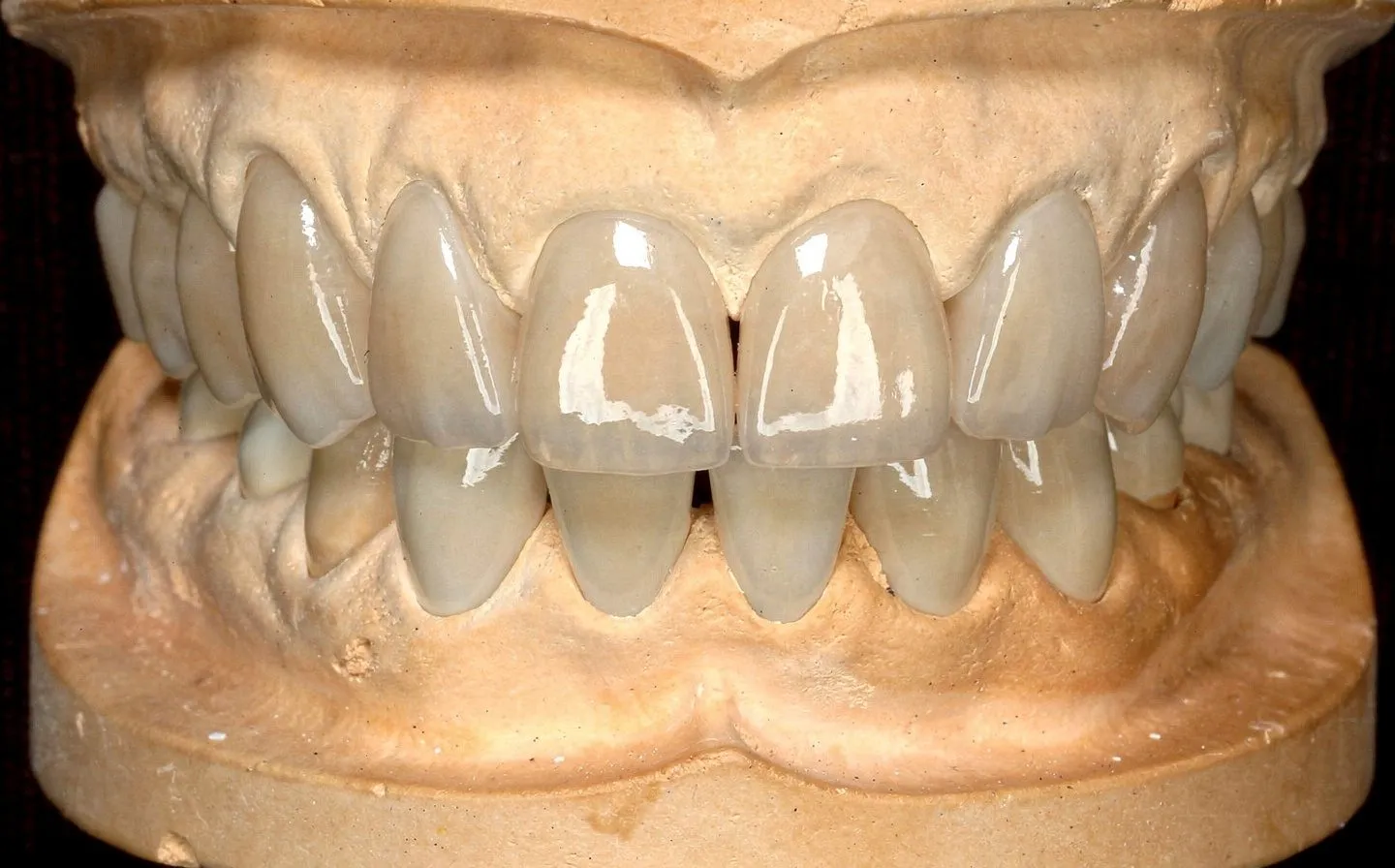 Full set of ceramic veneers/crowns on upper and lower arches displayed on plaster cast against black background