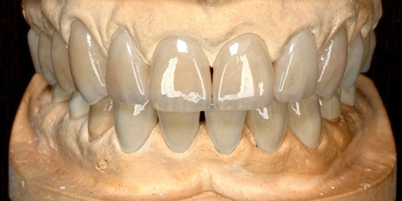 Dental Veneers Cost in Bhopal | Smile Gallery