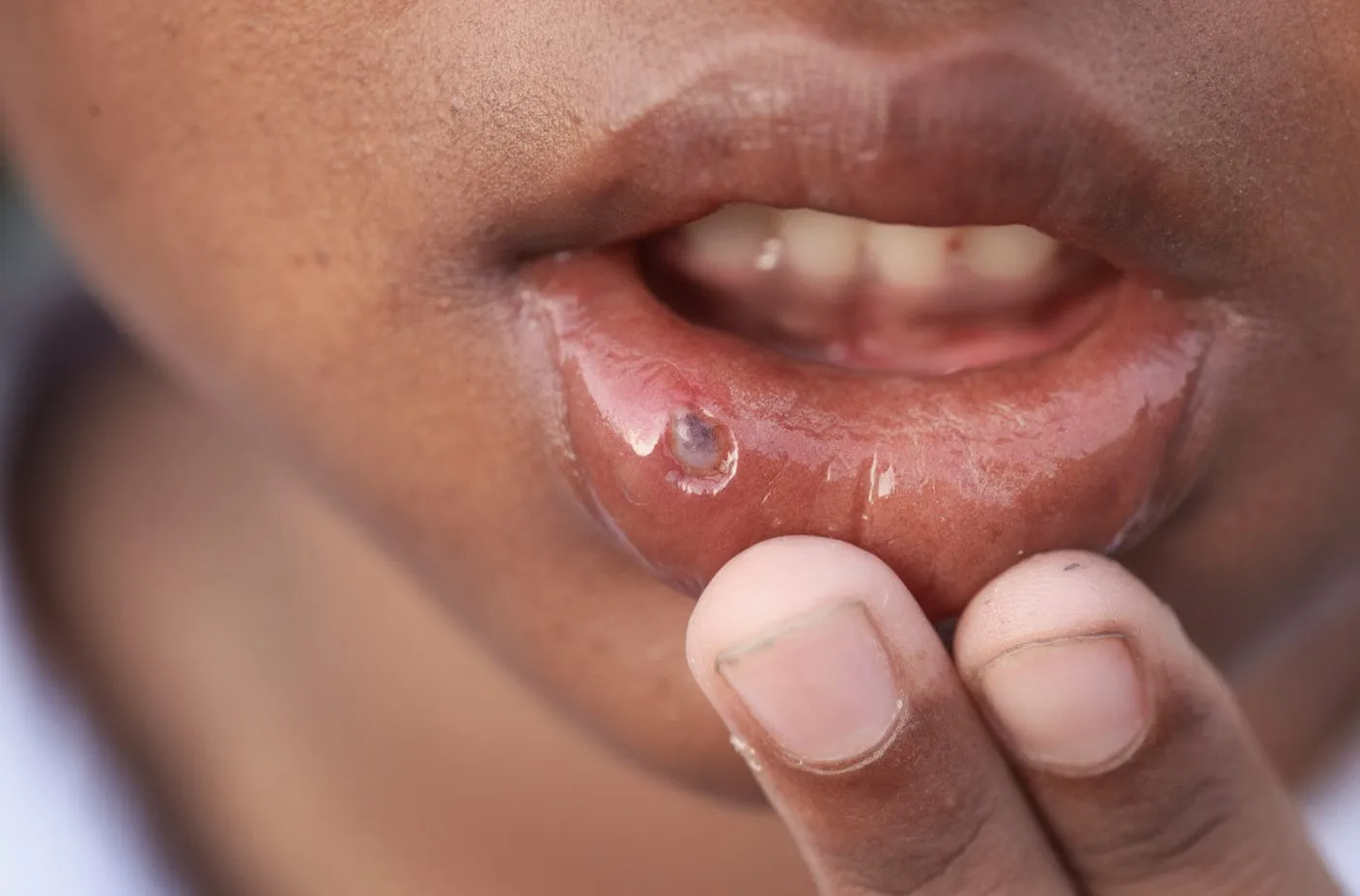 Extreme close-up of dark-skinned patient's lower lip pulled down showing aphthous ulcer/canker sore