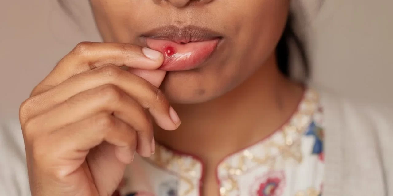 Mouth Ulcers Treatment: Tips for Relief