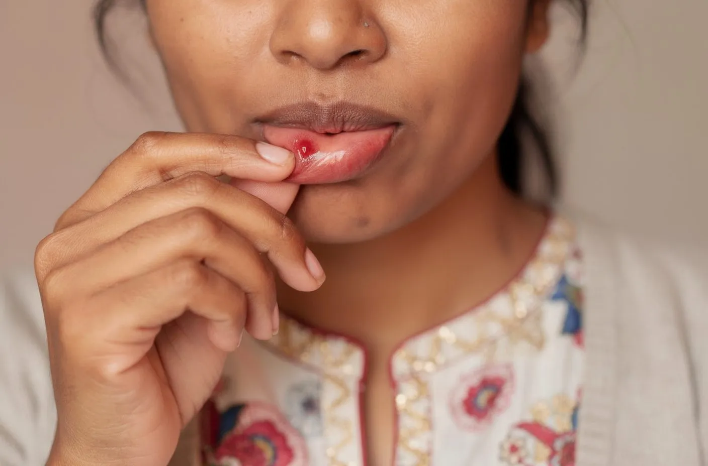South Asian woman pulling lower lip to show red ulcer/sore on inner lip mucosa; floral kurta background