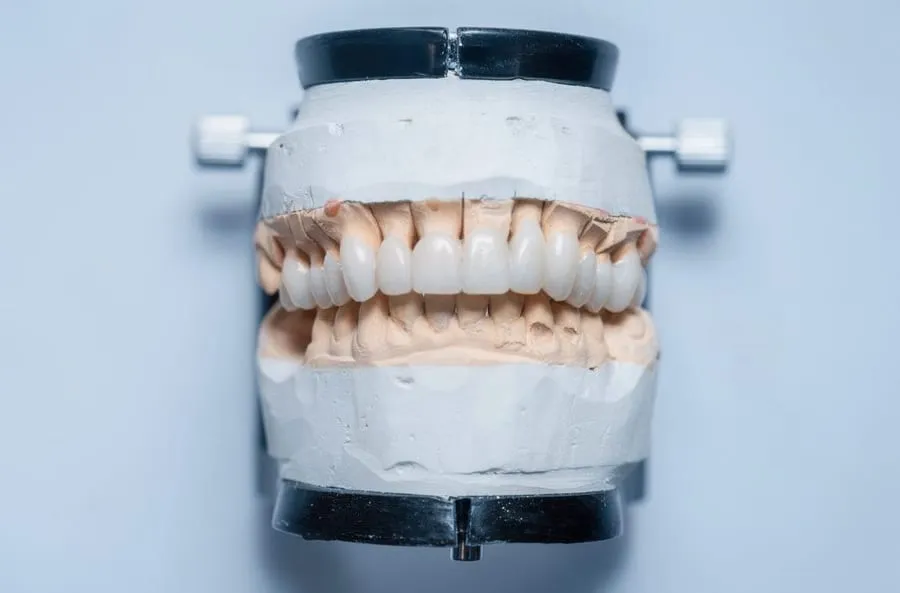 Full-arch dental cast with crowns on articulator