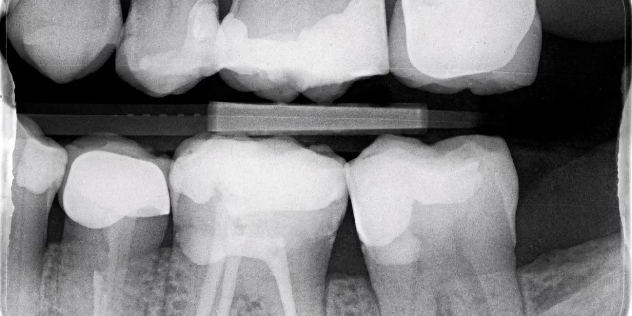 Dental X-Ray: Its Role in Dental Treatment