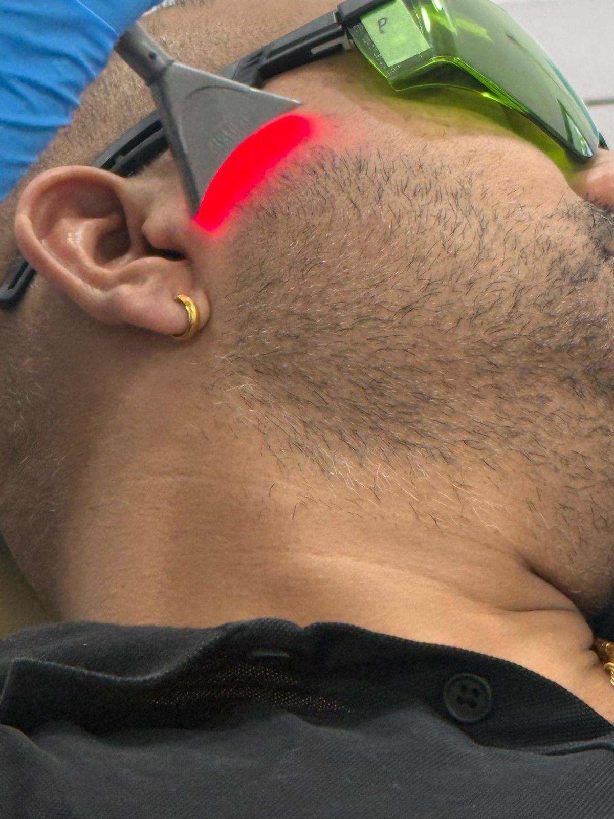 laser therapy applied for TMJ jaw pain at Smile Gallery Bhopal