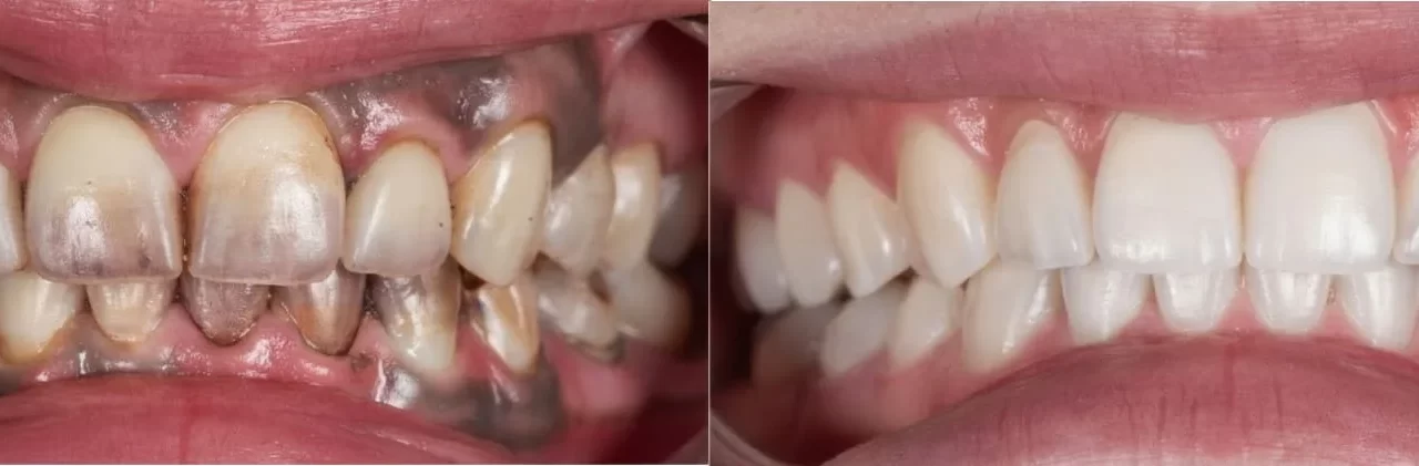 Top 5 Teeth Whitening Myths Debunked
