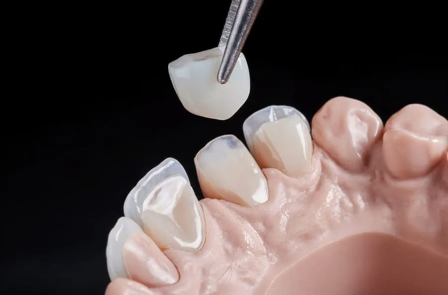 Dental veneer held in tweezers, macro shot