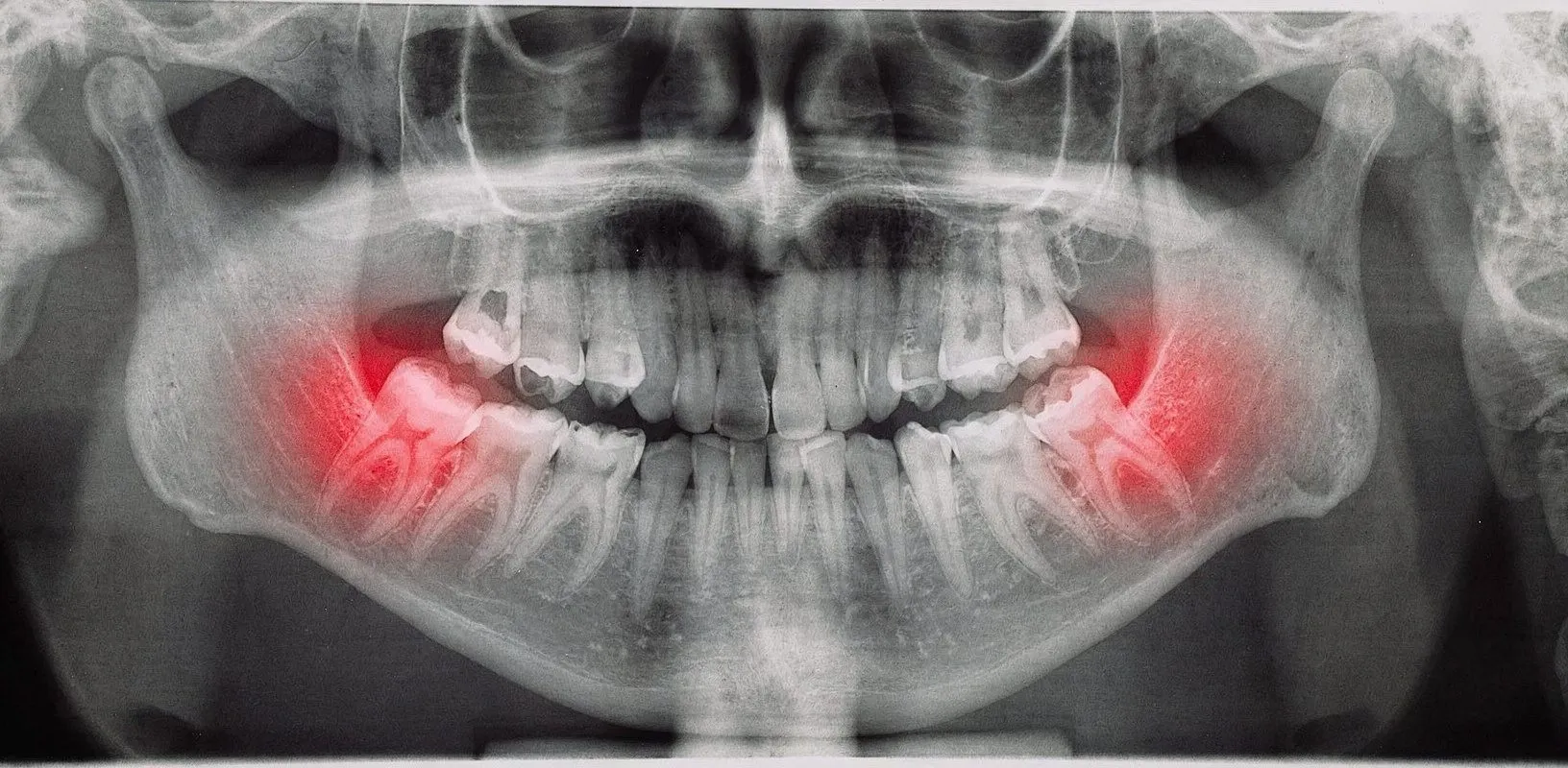 OPG panoramic X-ray with both lower wisdom tooth areas highlighted red/pink indicating impaction