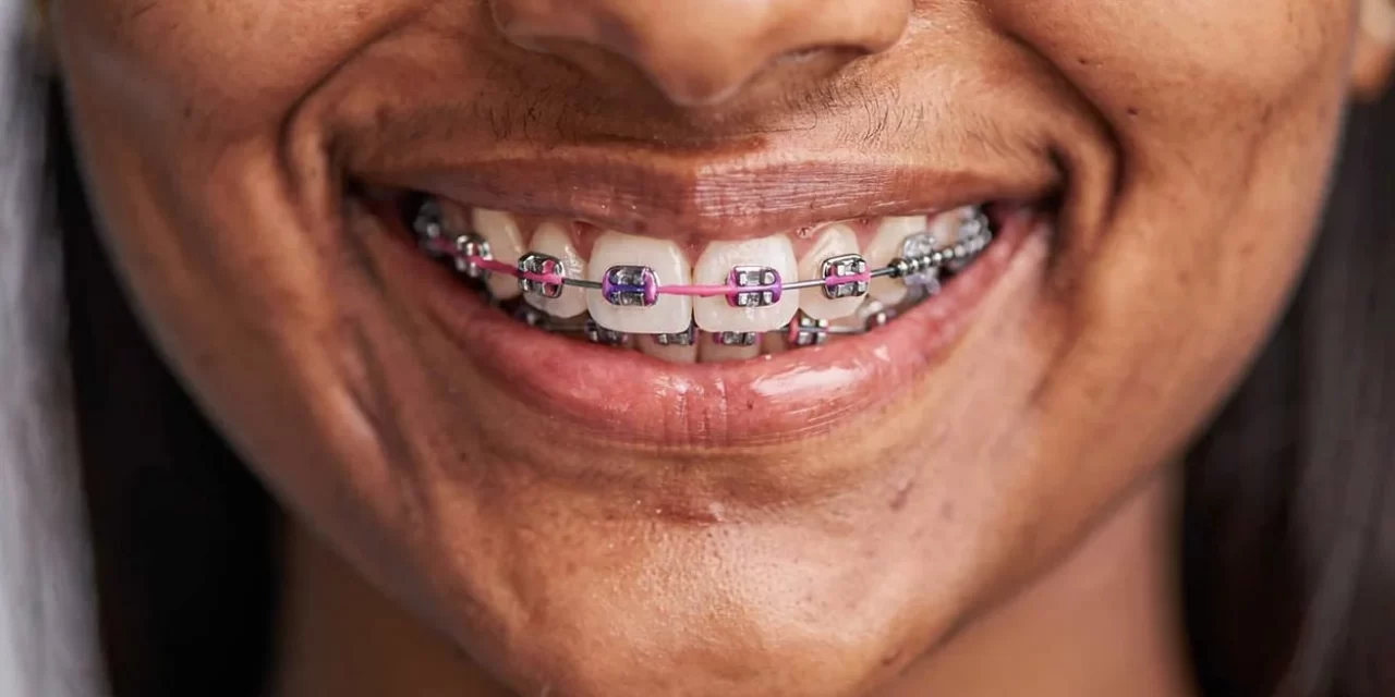 What is the Cost of Braces in Bhopal?