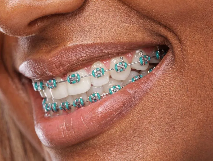 Closeup smile with teal braces ligatures