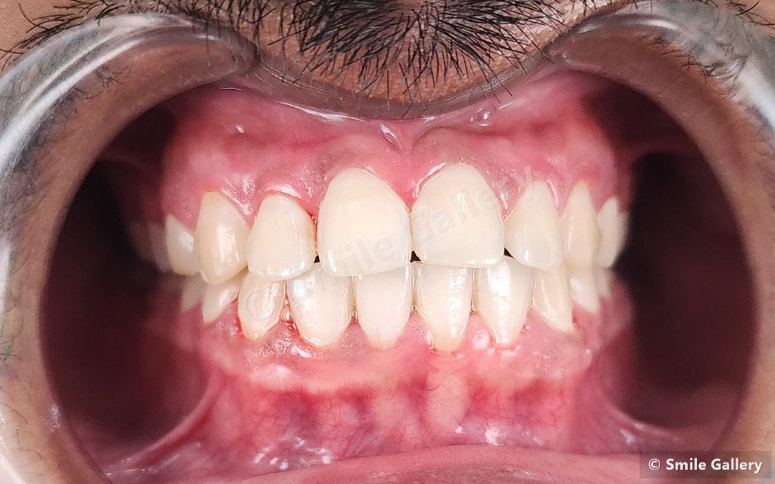 After braces: the upper midline space closed and both arches evenly aligned