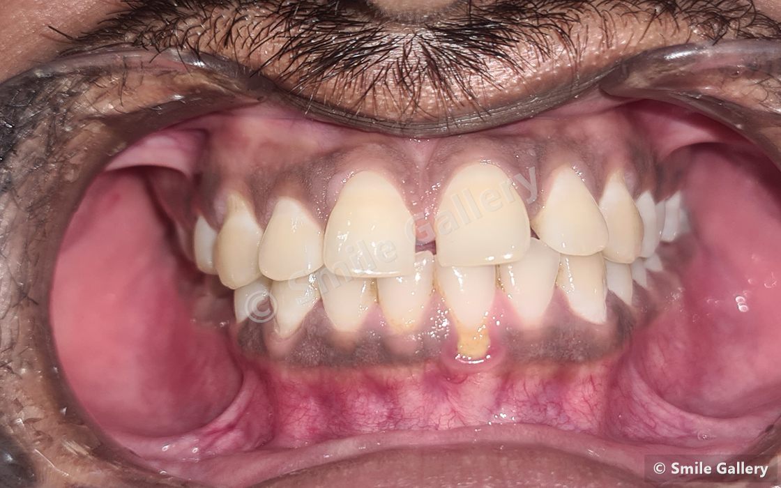 Before braces: a gap between the upper front teeth with the neighbouring teeth drifted out of line