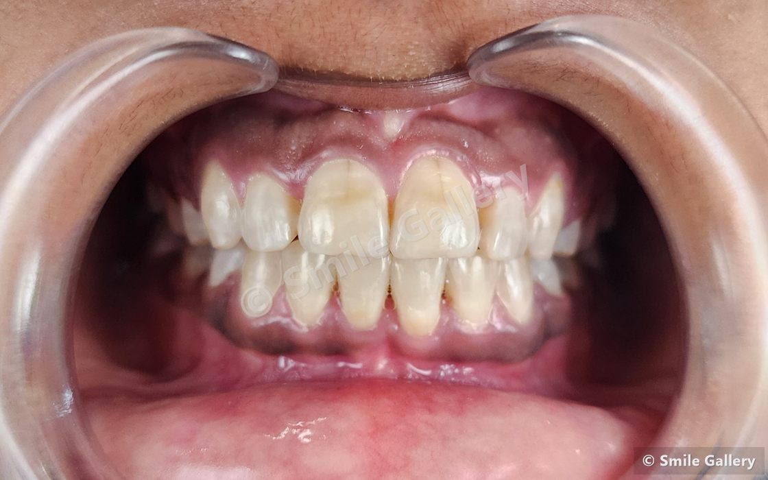 After braces: teeth separated and aligned, contact points now cleansable