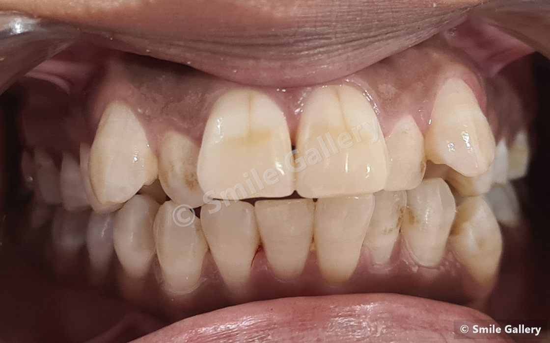 Before braces: overlapping crowded teeth with staining where a brush could not reach