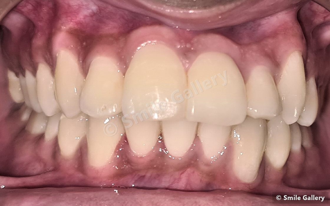 After braces: laterals rotated into the arch, producing a visibly broader smile line