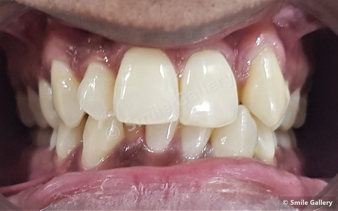 Before braces: two upper teeth rotated and hidden behind the arch