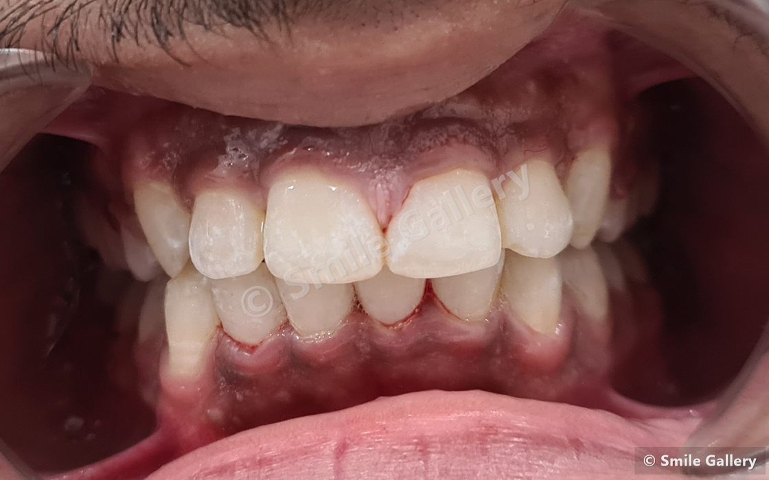After braces: space created and the canines guided down into an aligned arch