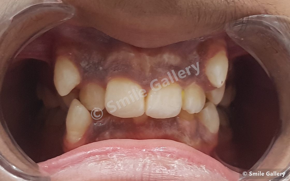 Before braces: severe crowding with the canines pushed high above the arch