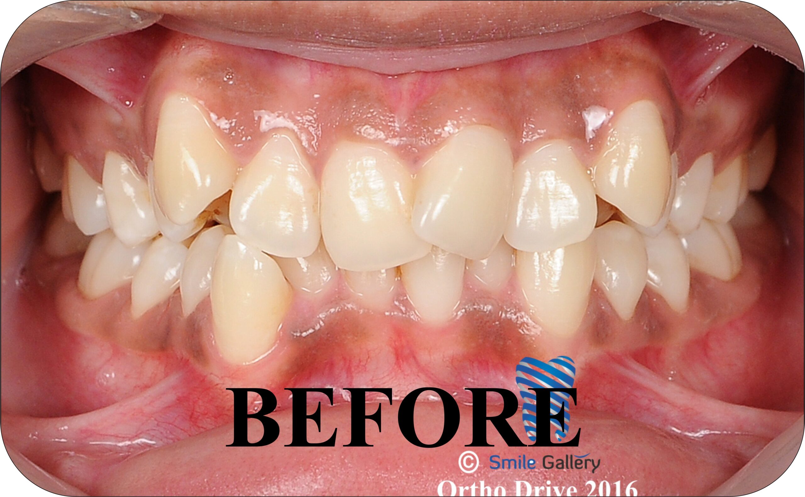 Before braces: crowded, rotated front teeth