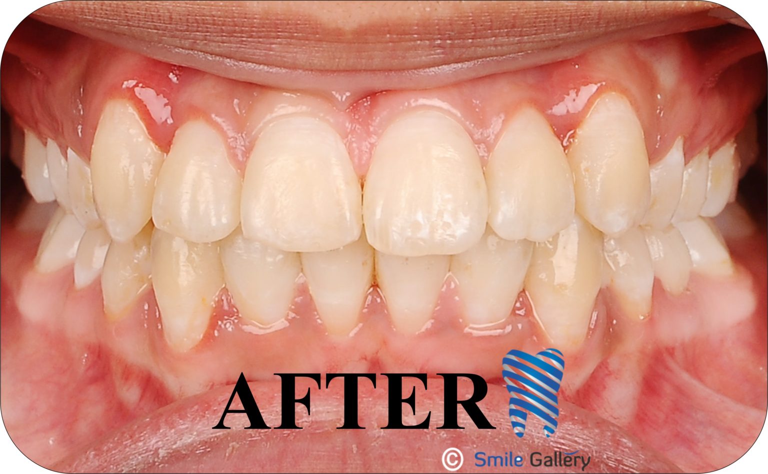 After braces: aligned smile following fixed orthodontic treatment