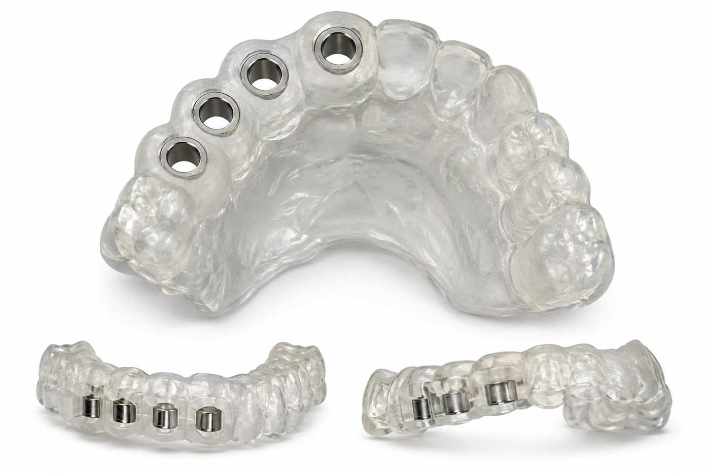 CBCT-planned 3D-printed surgical guides with titanium drill sleeves used for guided dental implant placement