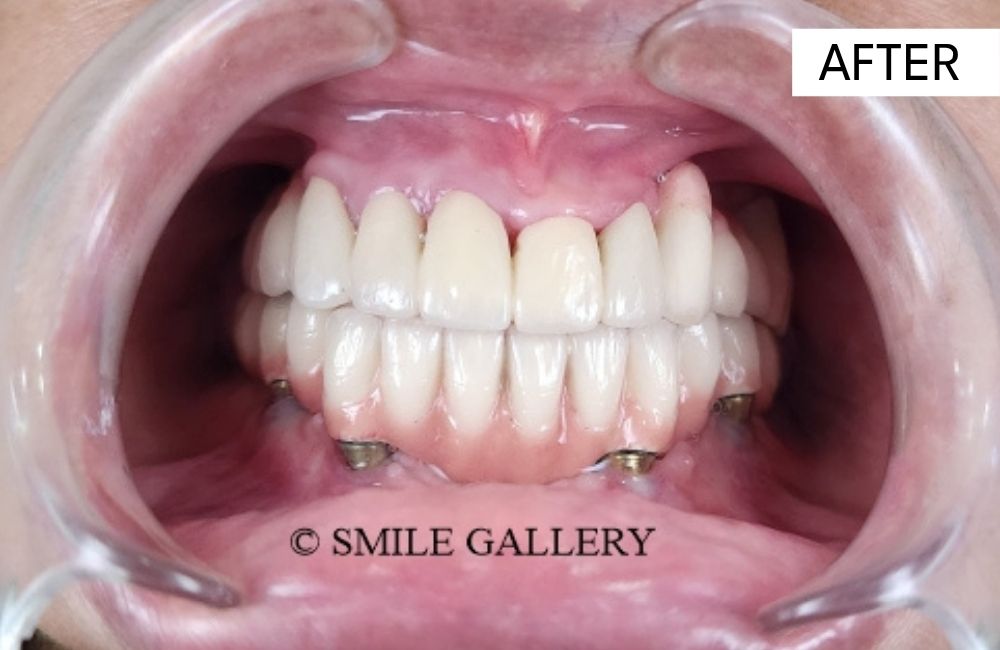 After: All-on-4 fixed full-arch implant prosthesis in place