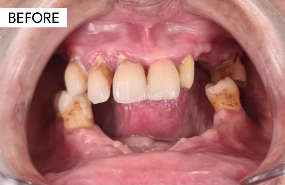 Before treatment: a failing upper arch requiring full-arch implant rehabilitation
