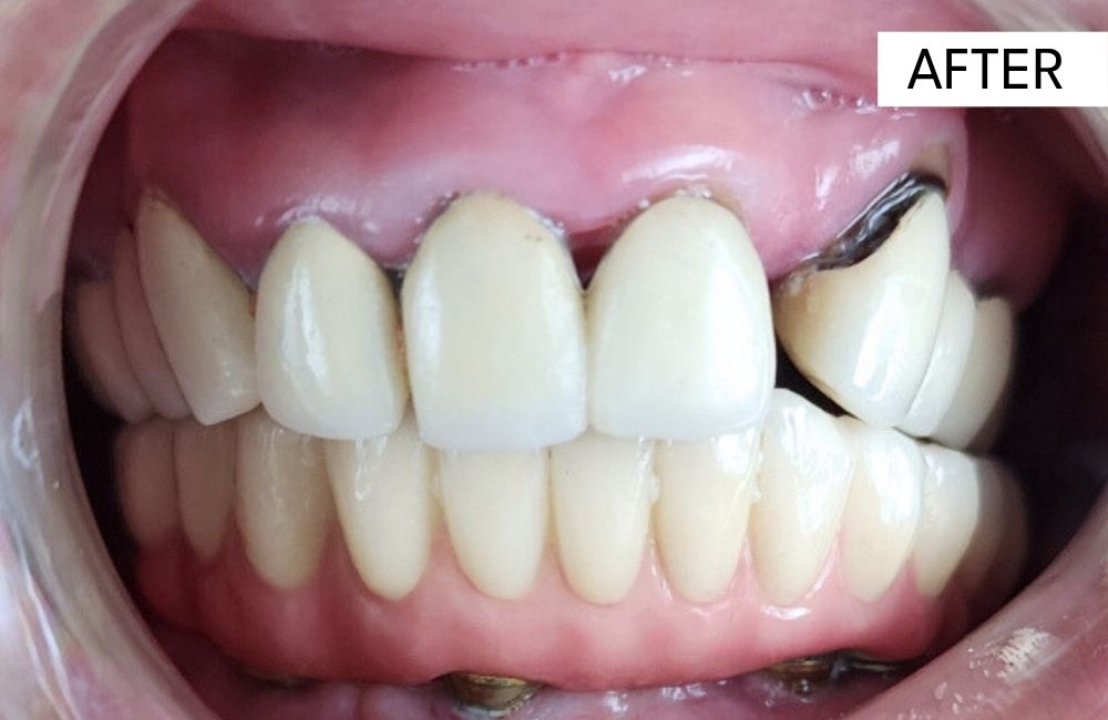 After: All-on-4 fixed full-arch implant prosthesis in place