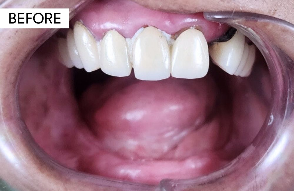Before treatment: extensive tooth loss with remaining teeth beyond repair