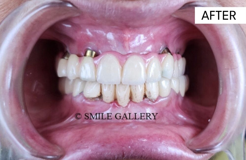 After: All-on-4 fixed full-arch implant prosthesis in place