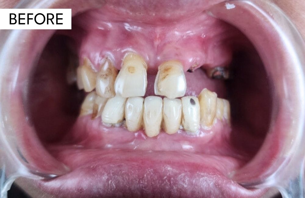 Before treatment: an edentulous arch planned for guided full-arch implant surgery