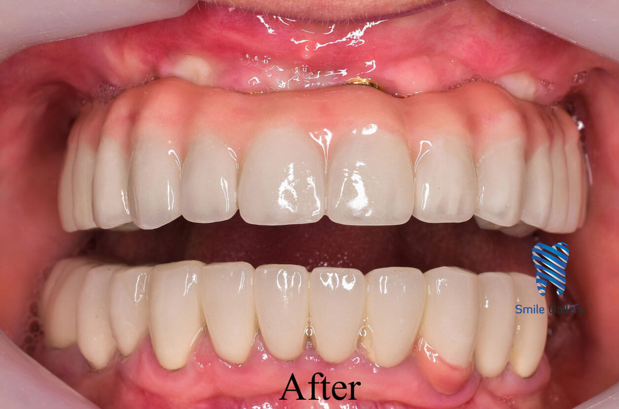 After: single-tooth implant crown in place