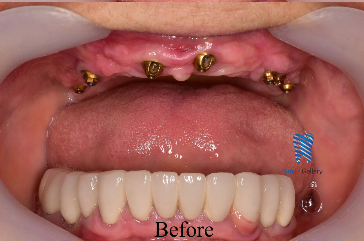 Before treatment: a single missing tooth leaving a gap in the arch