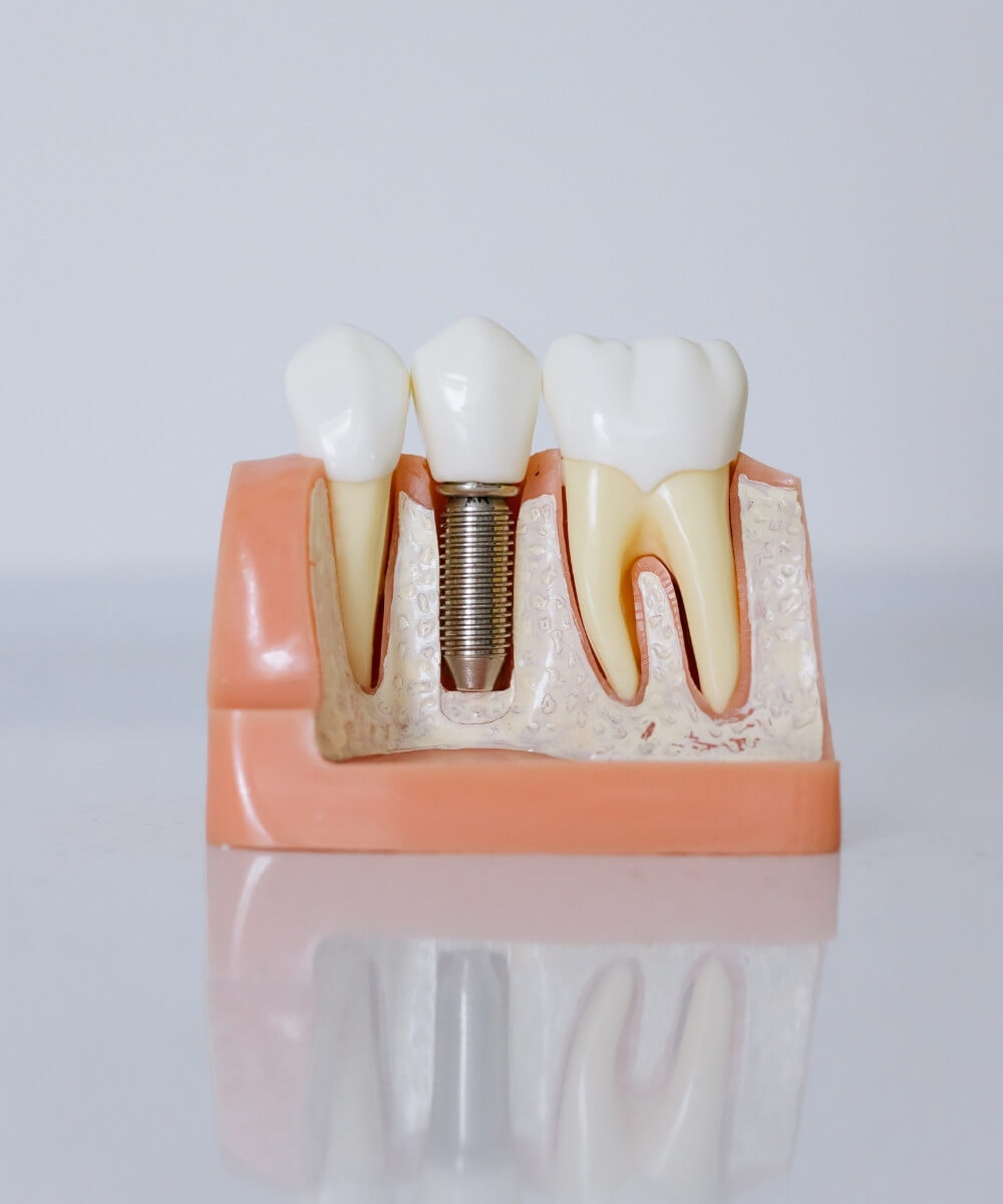 Dental implants in Bhopal at Smile Gallery Dental Wellness Centre