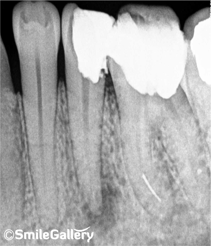 Before: X-ray of infected tooth requiring root canal treatment