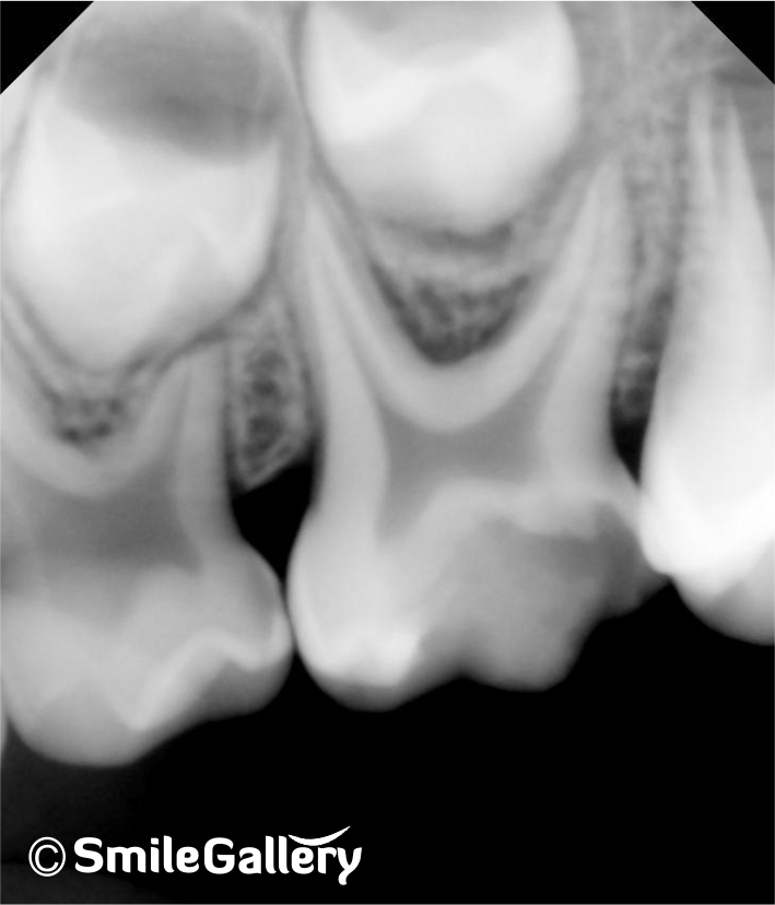 Before: X-ray of infected tooth requiring root canal treatment